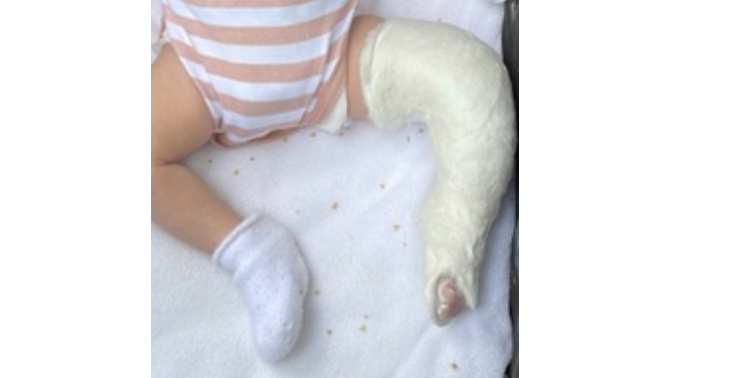 Treatment for my baby/clubfoot