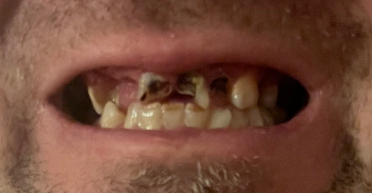Bitte hilf mir, wieder ohne Scham zu lächeln – ich brauche 8 Implantate