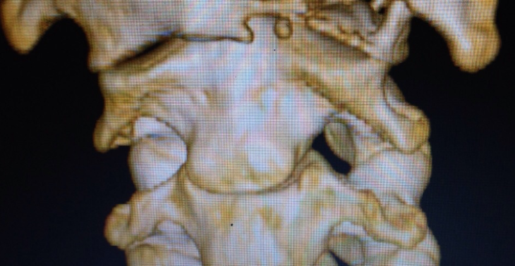 Tumor Plasmozytom Knochen Krebs